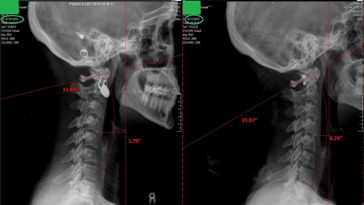 Cervical Curve Correction, an improvement to the cervical lordosis