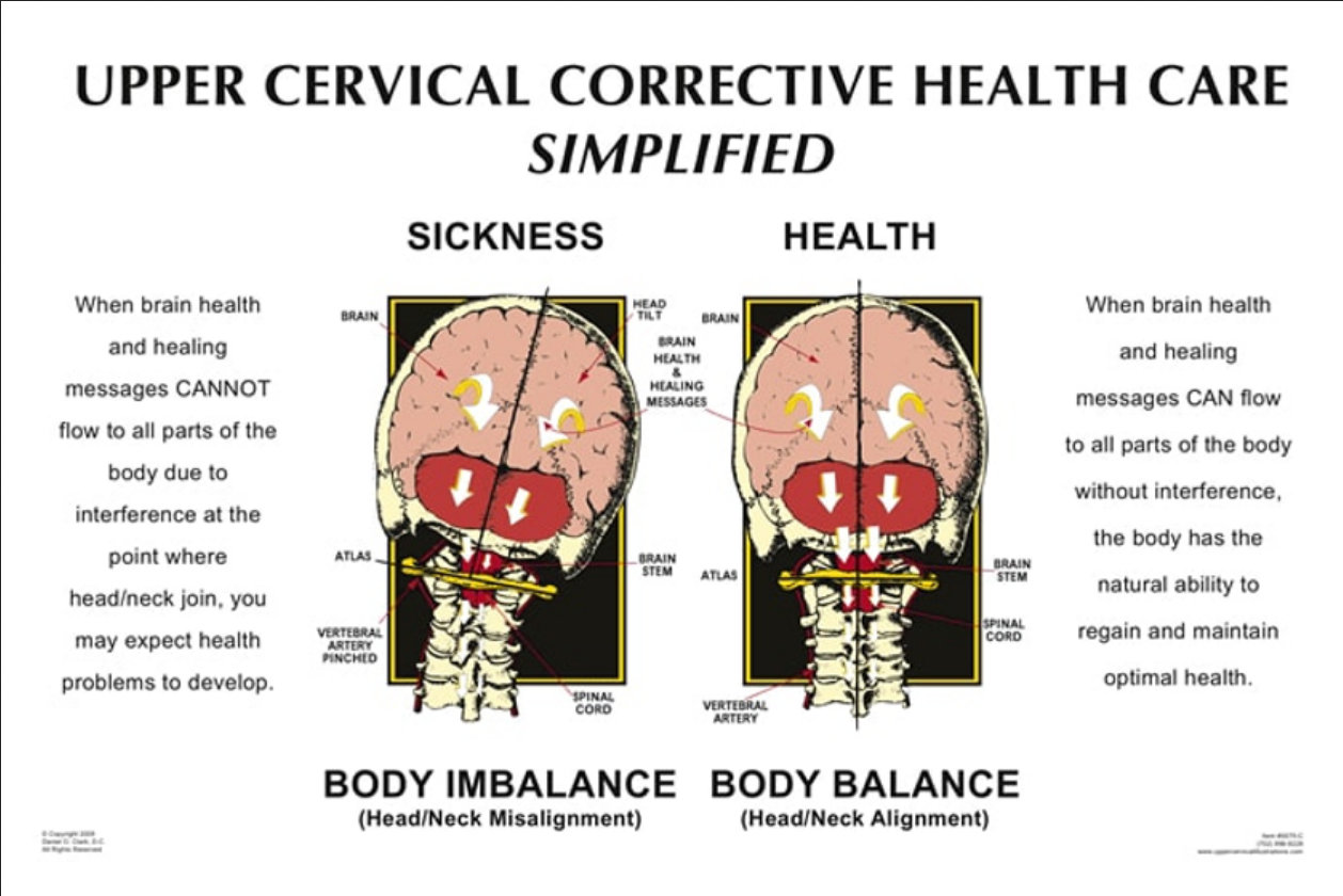 Causes of a upper cervical misalignment 