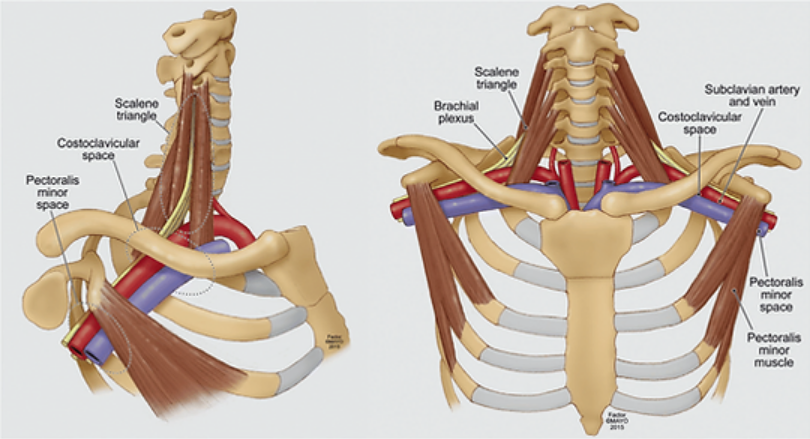 The Thoracic Outlet Syndrome: First Rib Subluxation Syndrome