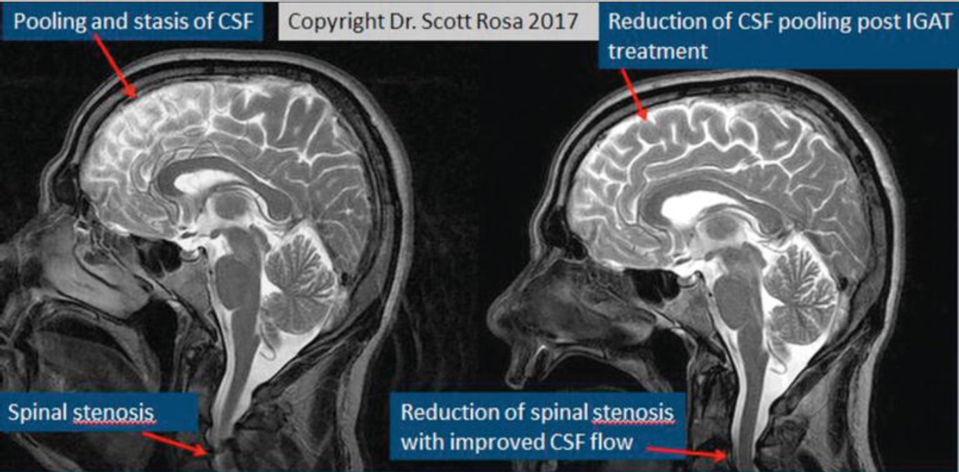 CSF before and after and upper cervical adjustment.