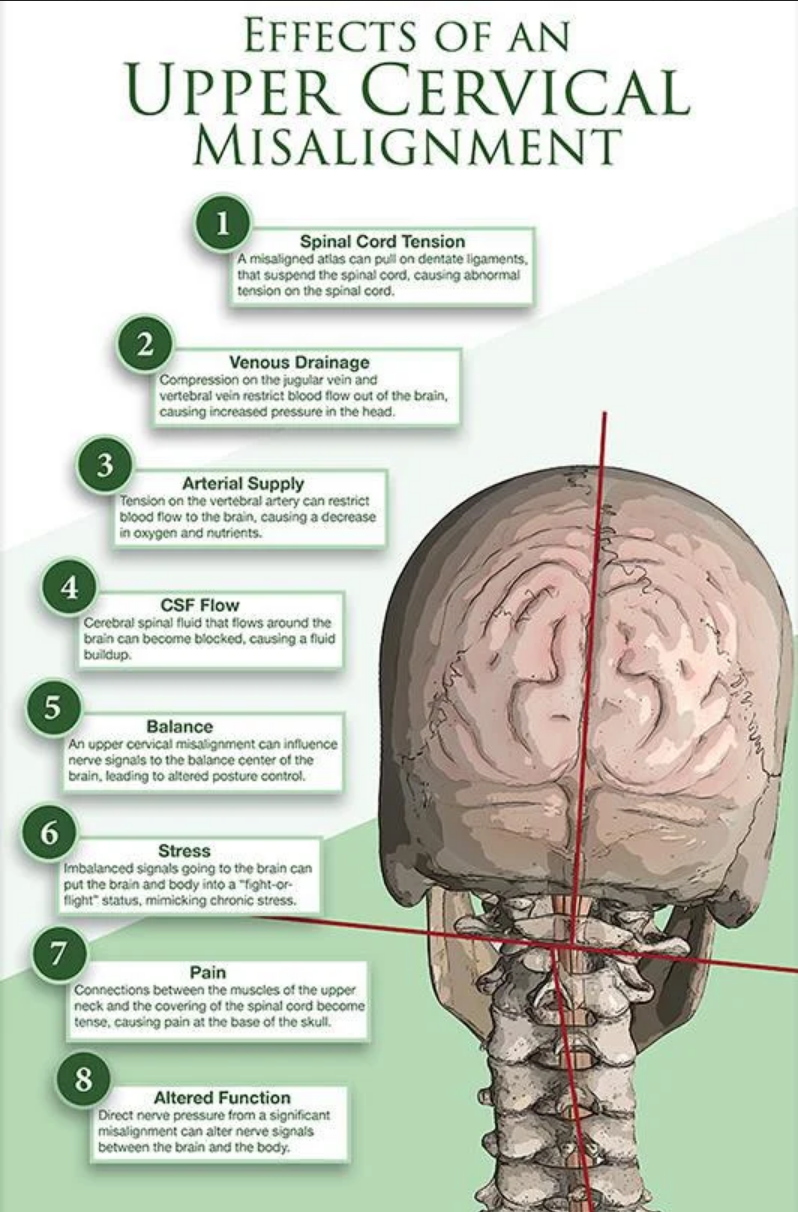 upper cervical misalignment 