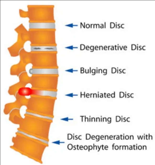 types of discs within your spine 