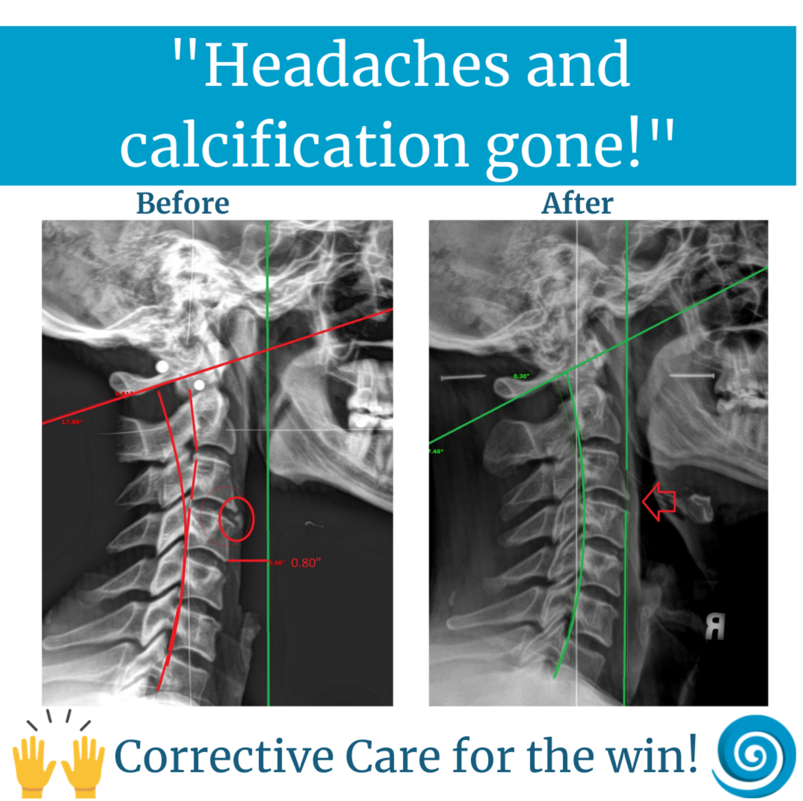 Is reversing my spinal arthritis possible? Koru Chiropractic