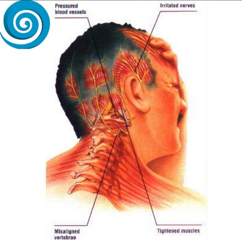 migraine pain