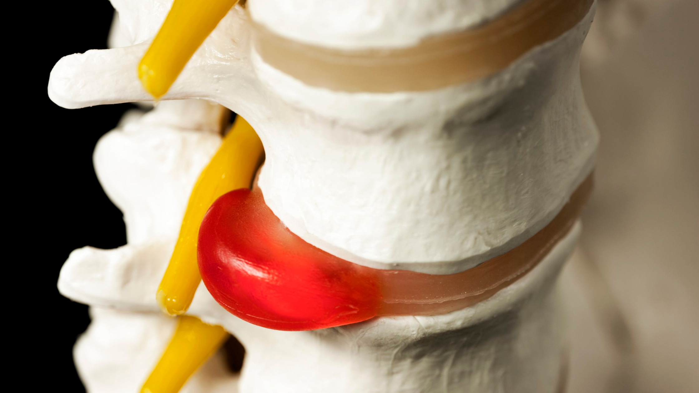How does disc bulging happen? Koru Chiropractic