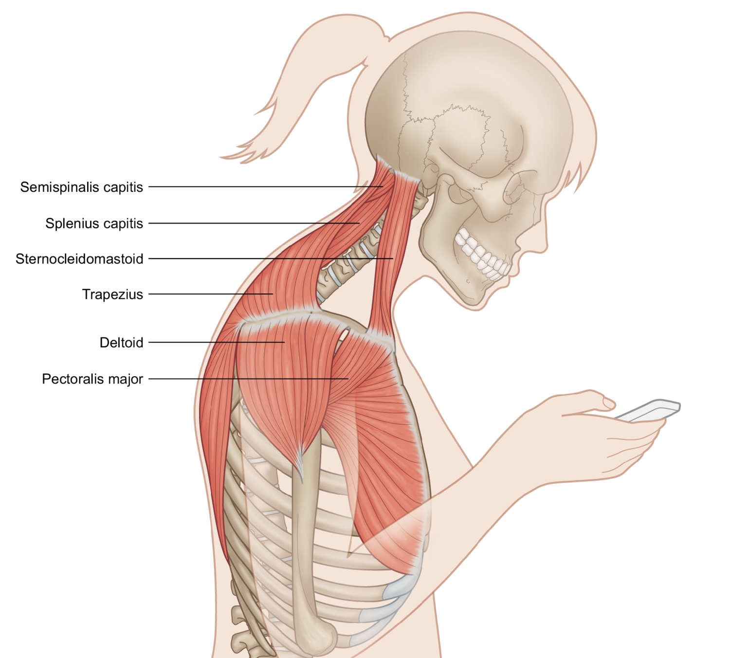 Thoracic Outlet Syndrome can be caused by Forward Head Posture