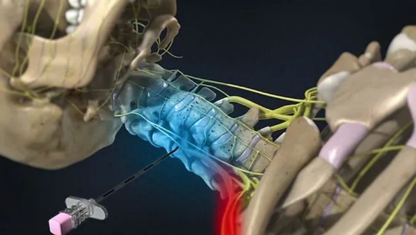 bulging disc injection