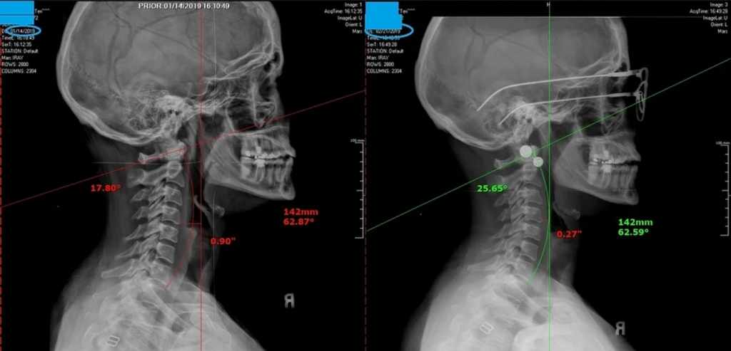 x-ray change