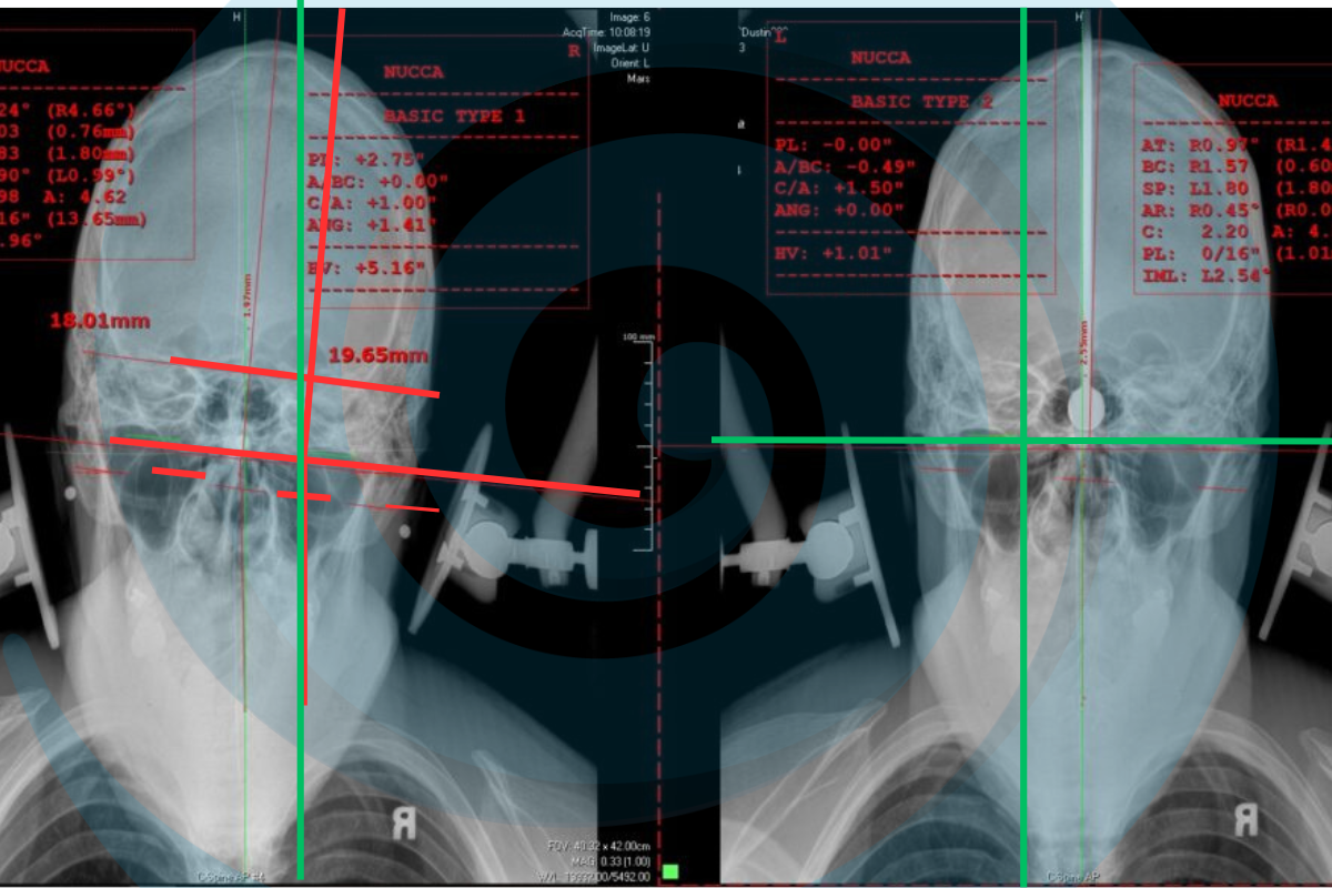 X-ray of before a nucca adjustment and afrer