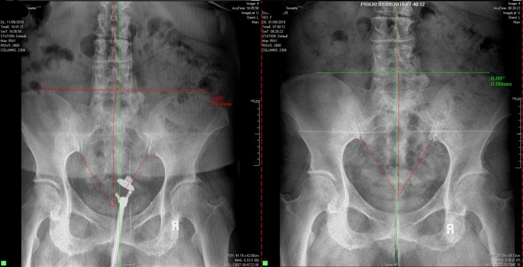 before and after x-rays helping sciatica pain 