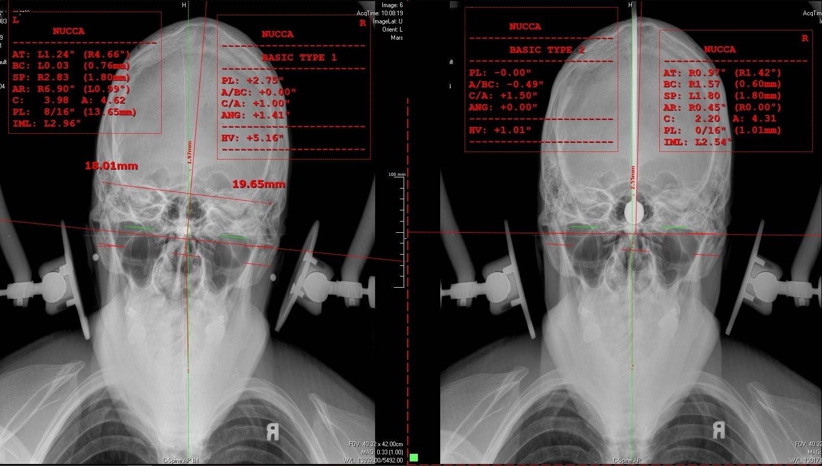 NUCCA misalignment Correction; before and after