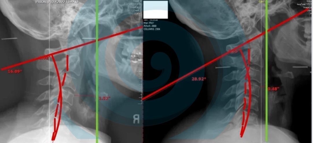 a before and after postural change visualized with x-ray on a patient with thoracic outlet syndrome.