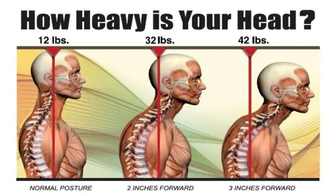 forward head posture