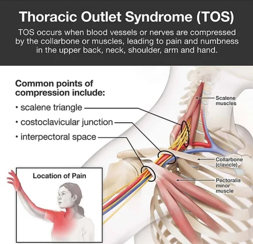 Areas most common for pain and other symptoms associated with TOS