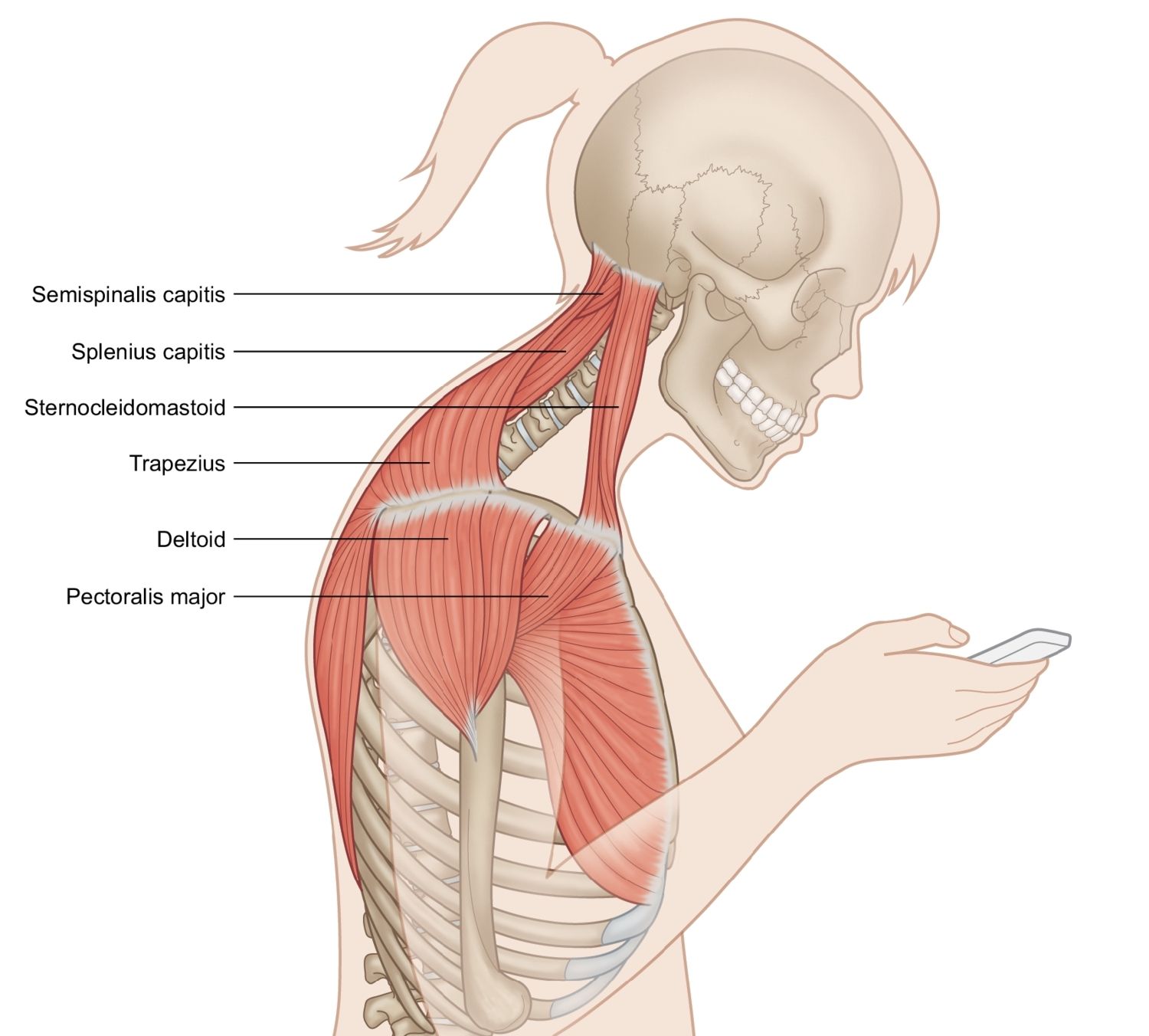 Thoracic Outlet Syndrome can be caused by Forward Head Posture