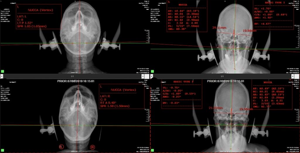 x-ray examples for NUCCA 