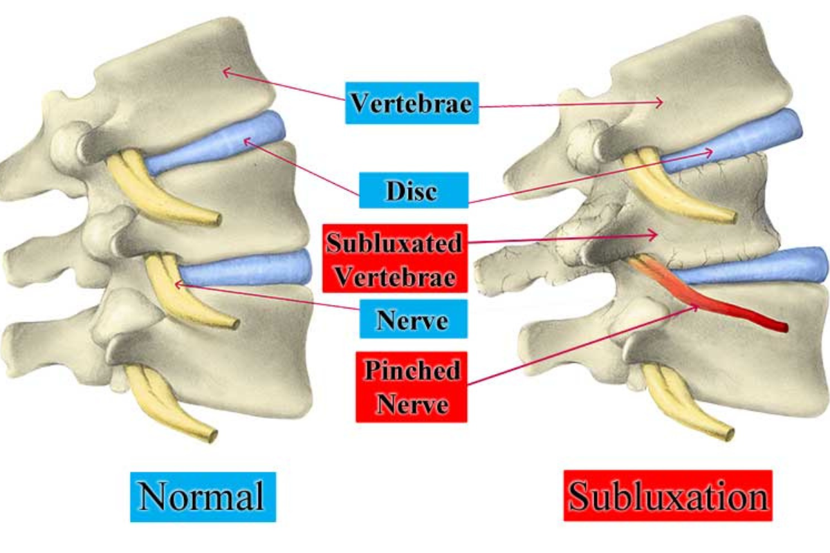 difference between a normal spine vs a subluxation 