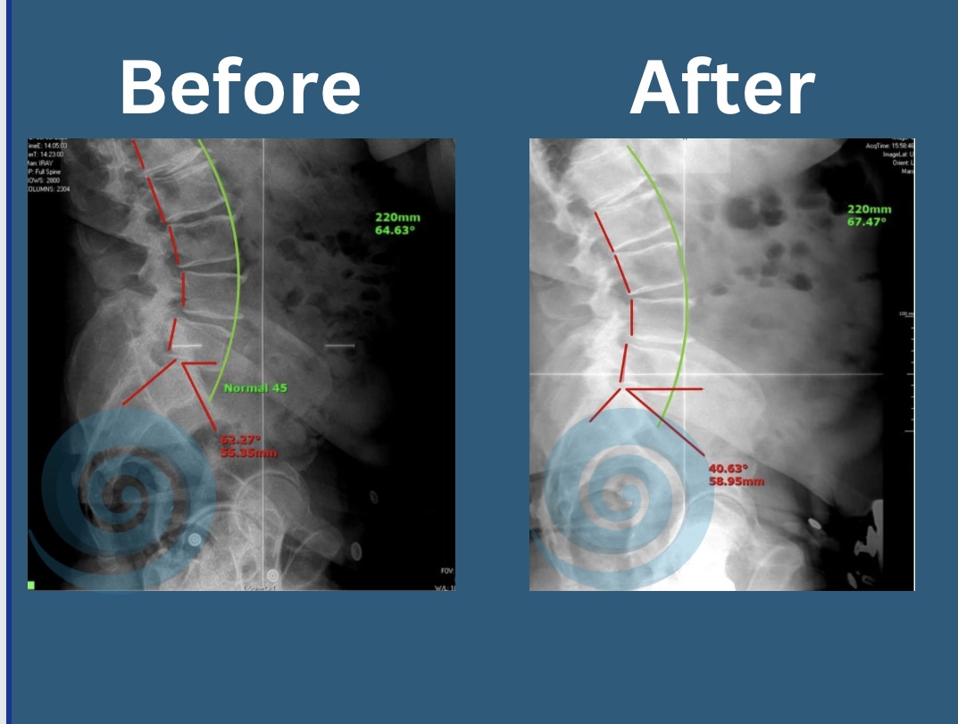 before and after chiropractic care treating retrolisthesis 