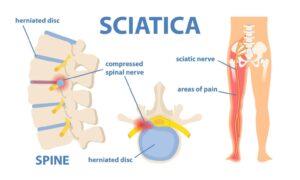 symptoms and causes of sciatica