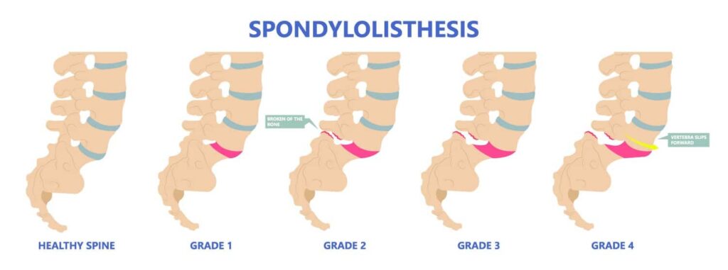 Progression of spondylolisthesis 