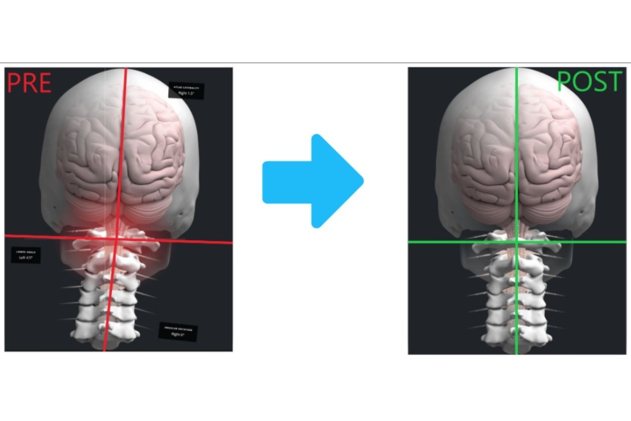 Upper cervical misalignment