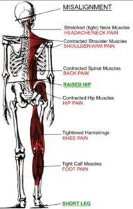 symptoms an upper cervical misalignment