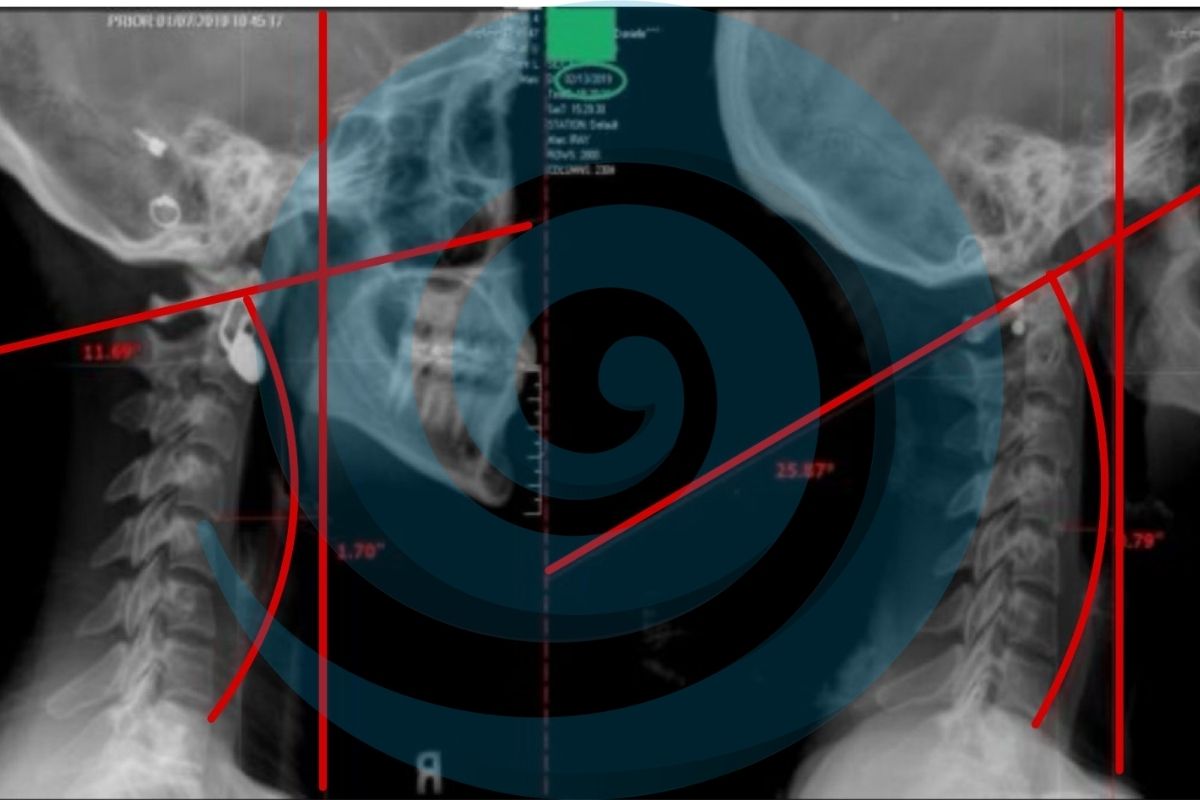 the cervical neck after chiropractic care
