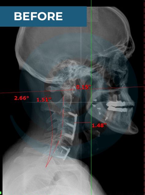x-ray of a neck post surgey, before chiropractic care 