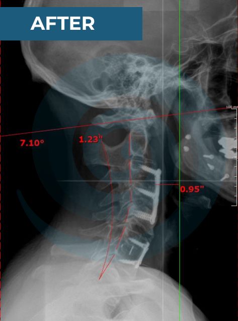 an x-ray of a neck post surgery, after consistent chiropractic care