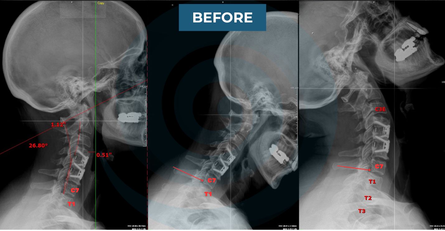 cervical xrays of someone with spinal surgery 
