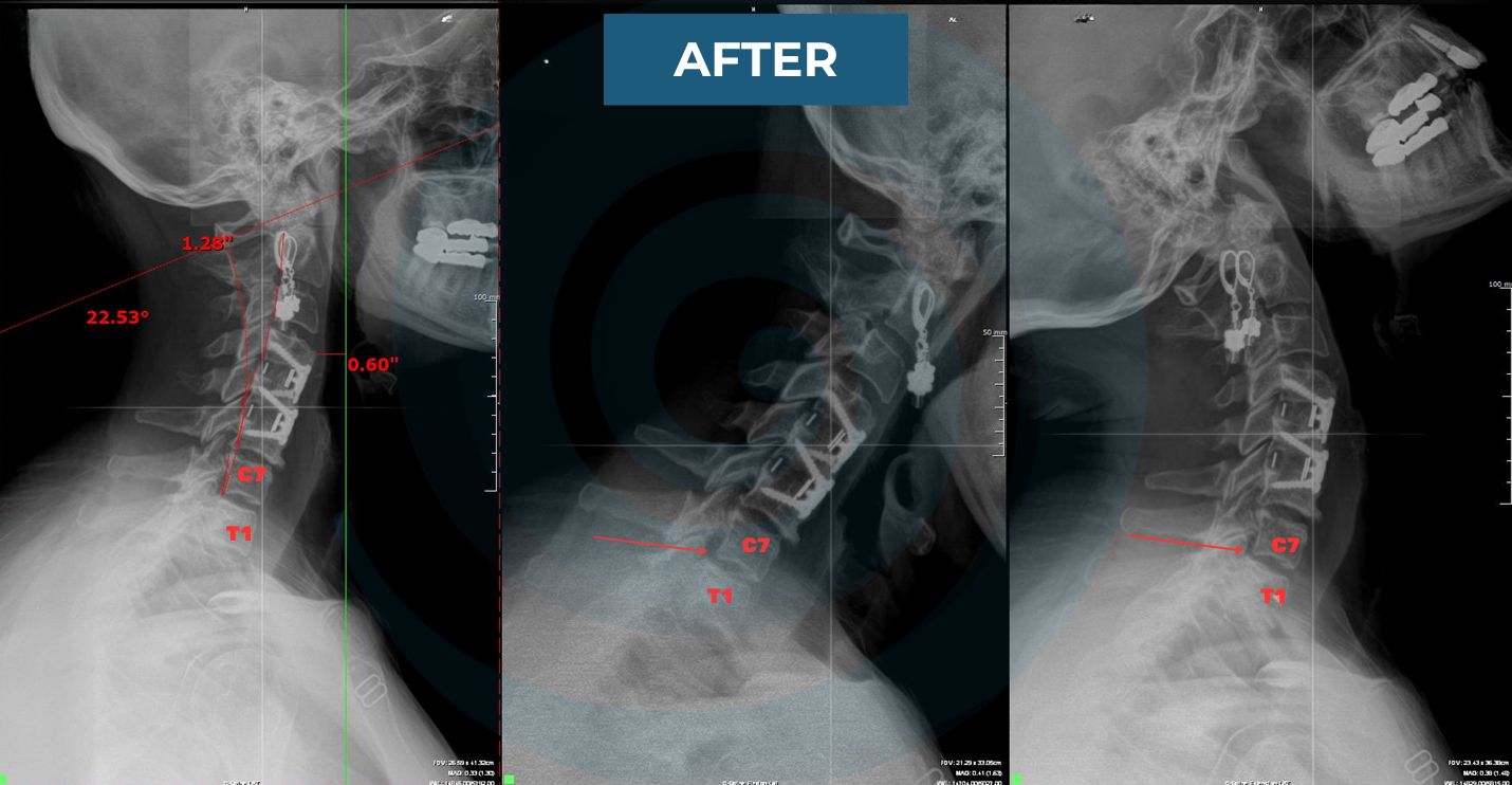 cervical xrays post chiropractic care